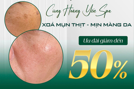 dich-vu-xoa-mun-thit